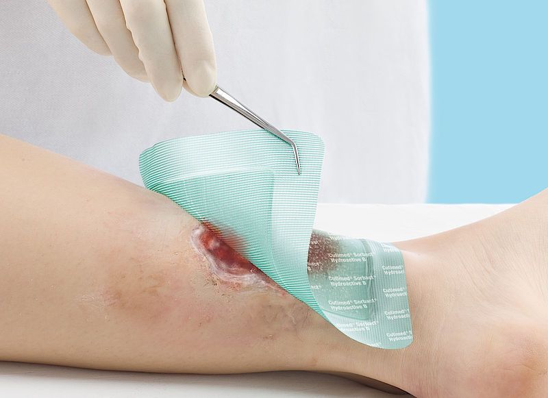 Feridas Neoplásicas