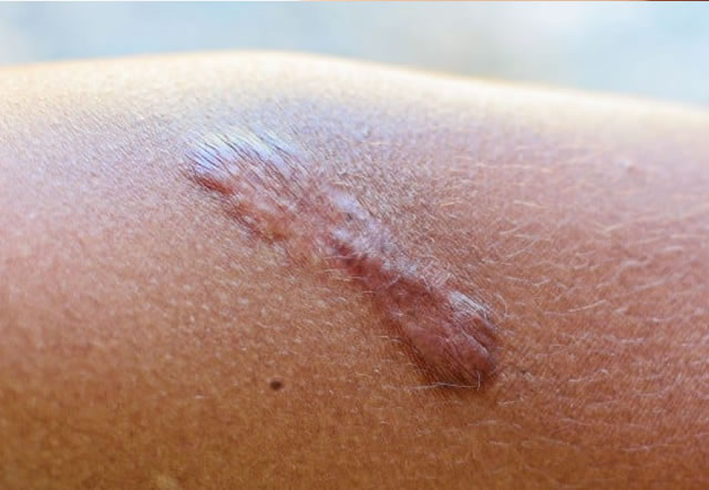 Cicatrizes e Queloides (Reparação)